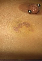 Abused nipple