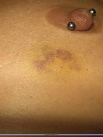Abused nipple