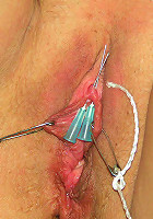 Needles in Clitoris