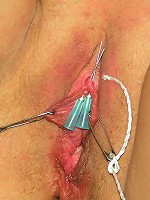 Needles in Clitoris